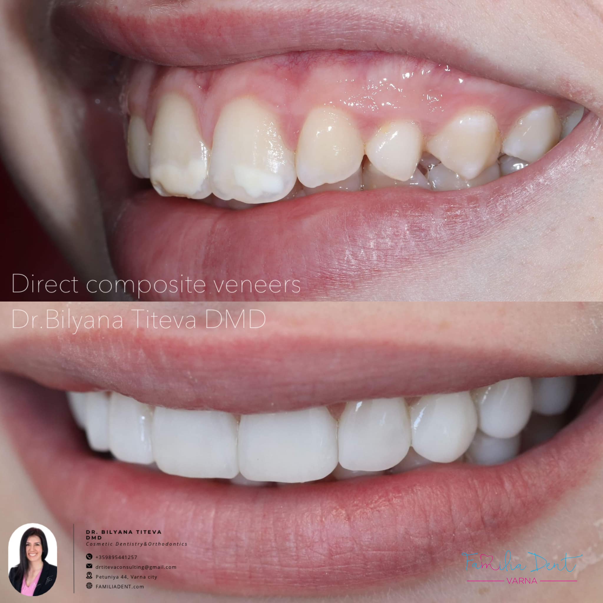 TOKUYAMA ASTERIA ESTELITE